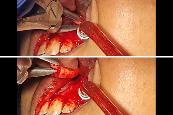 Oral Surgery